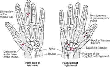 Hand Injuries